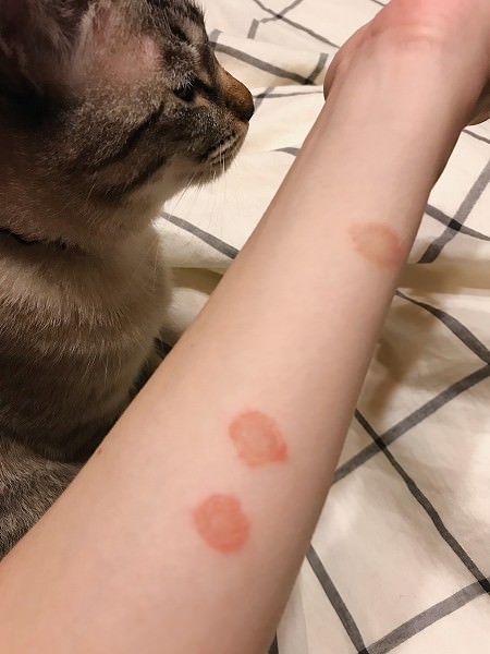 猫の真菌に感染してできた腕の湿疹